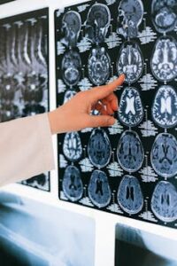 A doctor's hand points to a brain MRI scan on a lightbox, illustrating medical diagnosis.